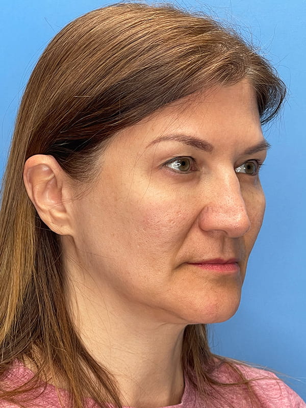 Lower Facelift<br>(SMAS Lift) Before & After Image