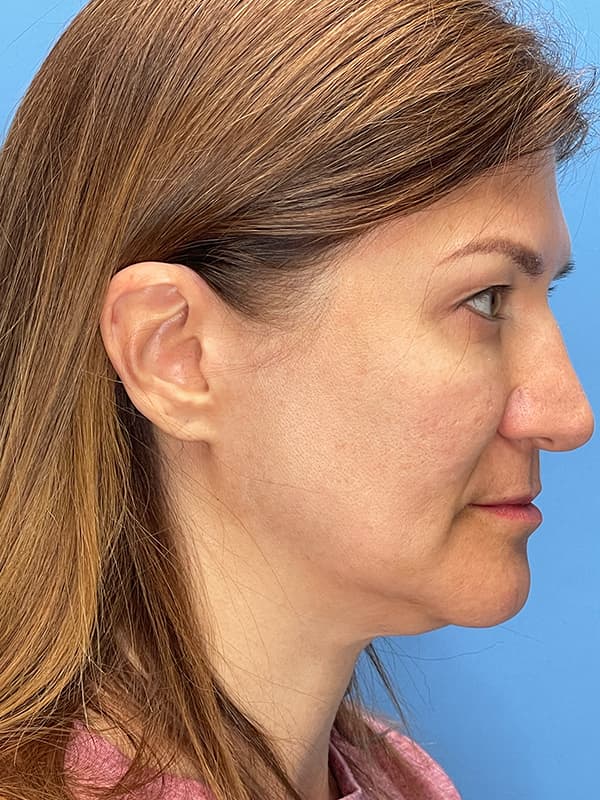 Lower Facelift<br>(SMAS Lift) Before & After Image