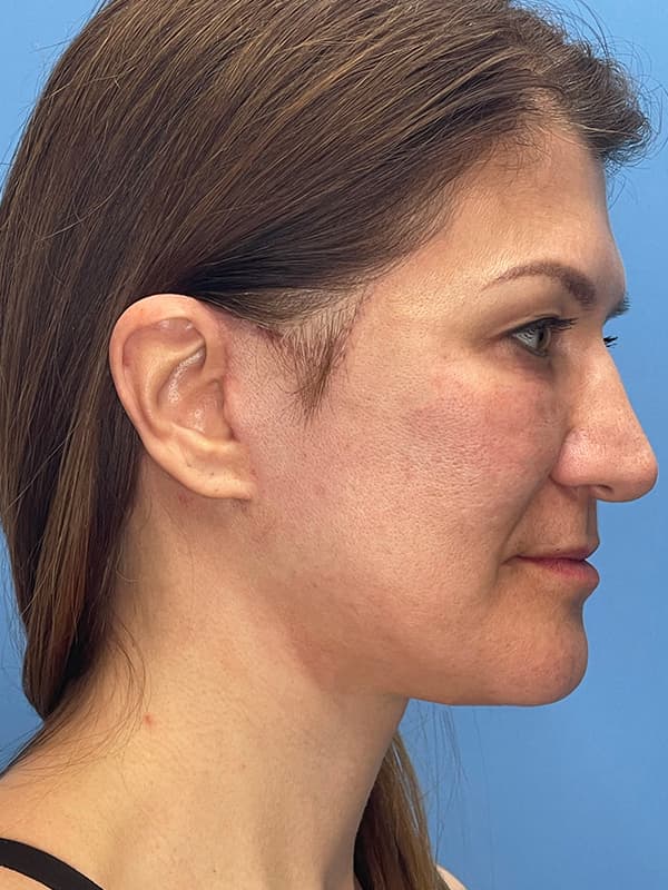 Lower Facelift<br>(SMAS Lift) Before & After Image