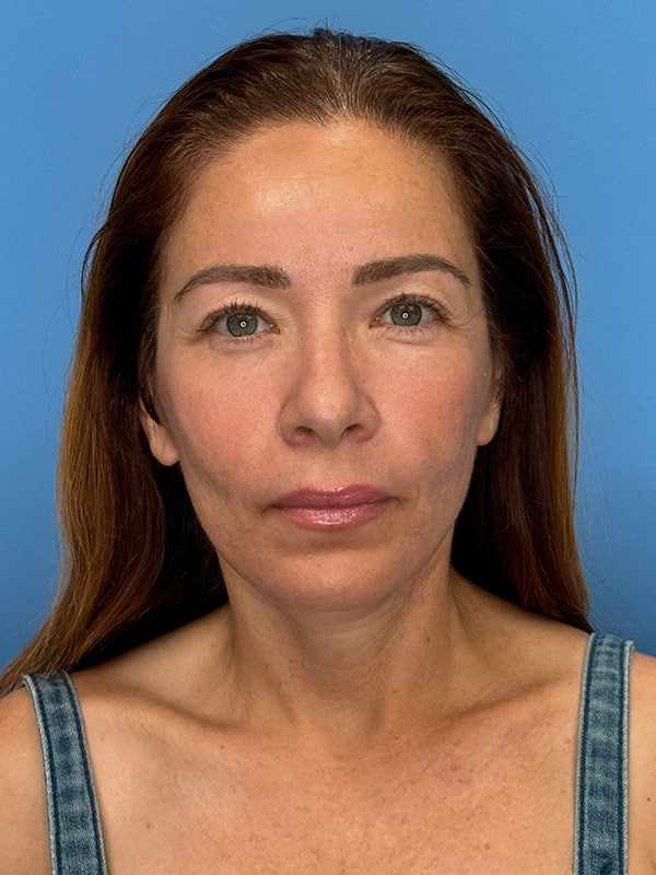 Lower Facelift<br>(SMAS Lift) Before & After Image