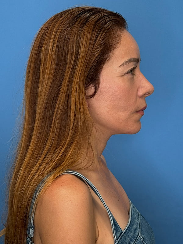 Lower Facelift<br>(SMAS Lift) Before & After Image