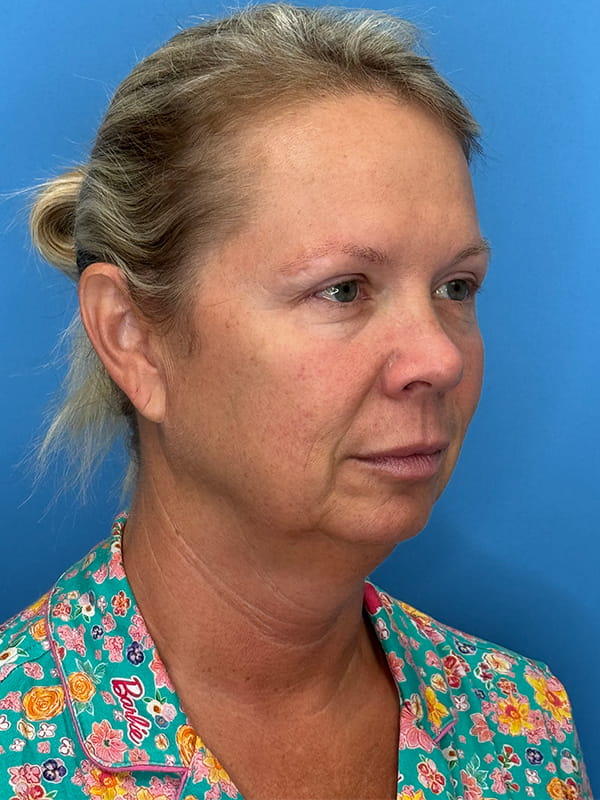 Lower Facelift<br>(SMAS Lift) Before & After Image