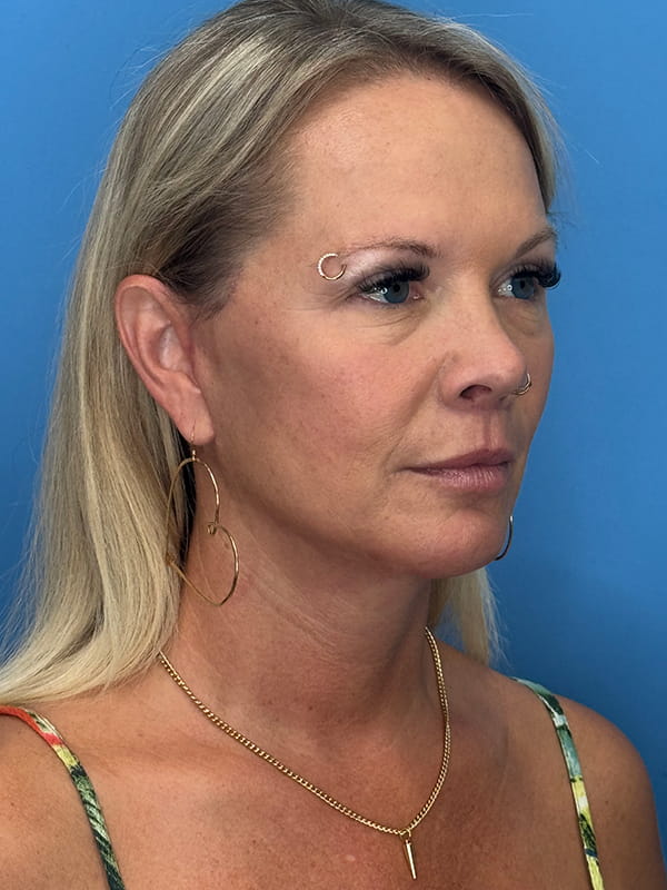 Lower Facelift<br>(SMAS Lift) Before & After Image