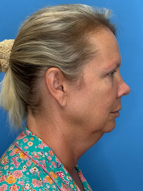 Lower Facelift<br>(SMAS Lift) Before & After Image