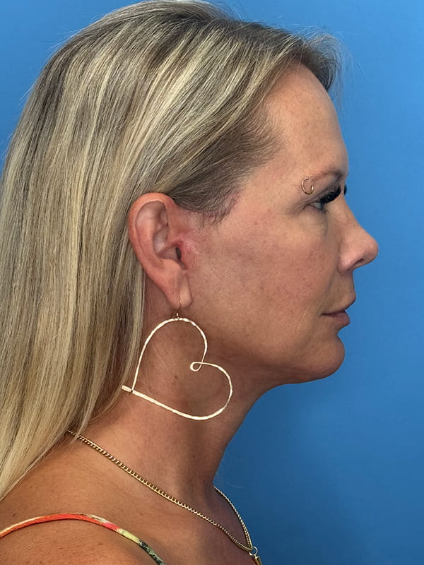 Lower Facelift<br>(SMAS Lift) Before & After Image