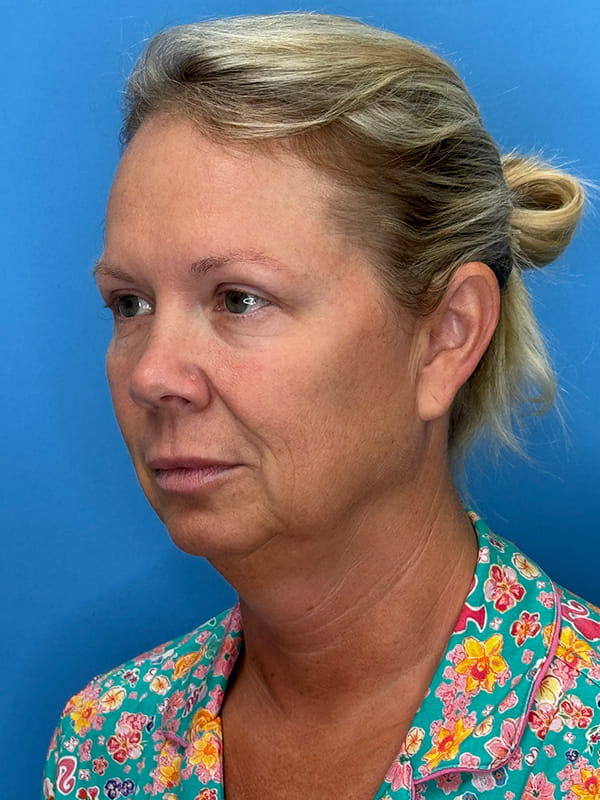 Lower Facelift<br>(SMAS Lift) Before & After Image