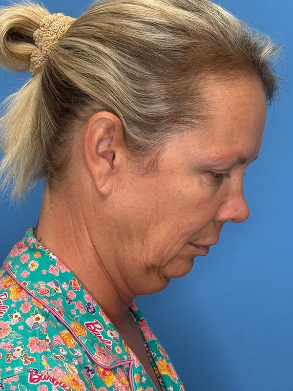 Lower Facelift<br>(SMAS Lift) Before & After Image