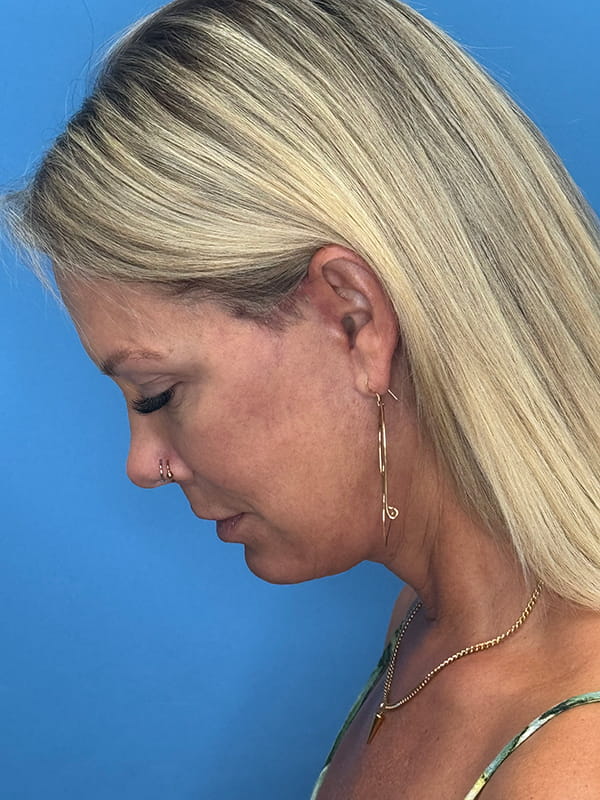 Lower Facelift<br>(SMAS Lift) Before & After Image