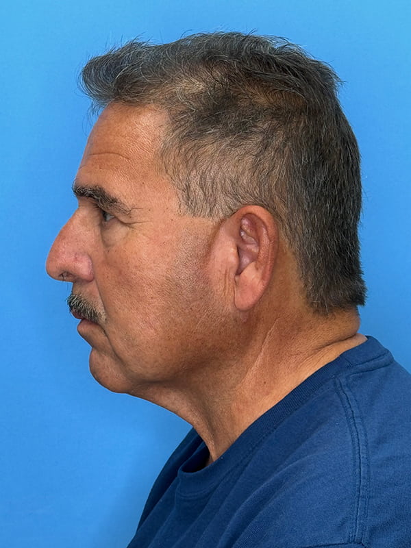 Neck Lift Before & After Image