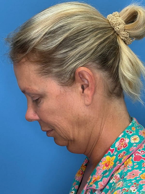 Neck Lift Before & After Image