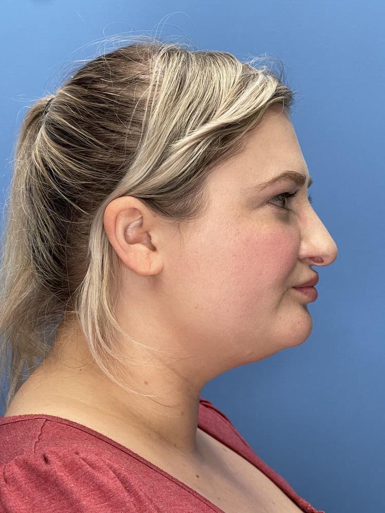 Neck Liposuction Before & After Image