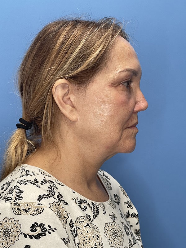 Revision Facelift Before & After Image