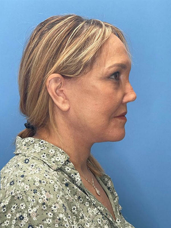 Revision Facelift Before & After Image