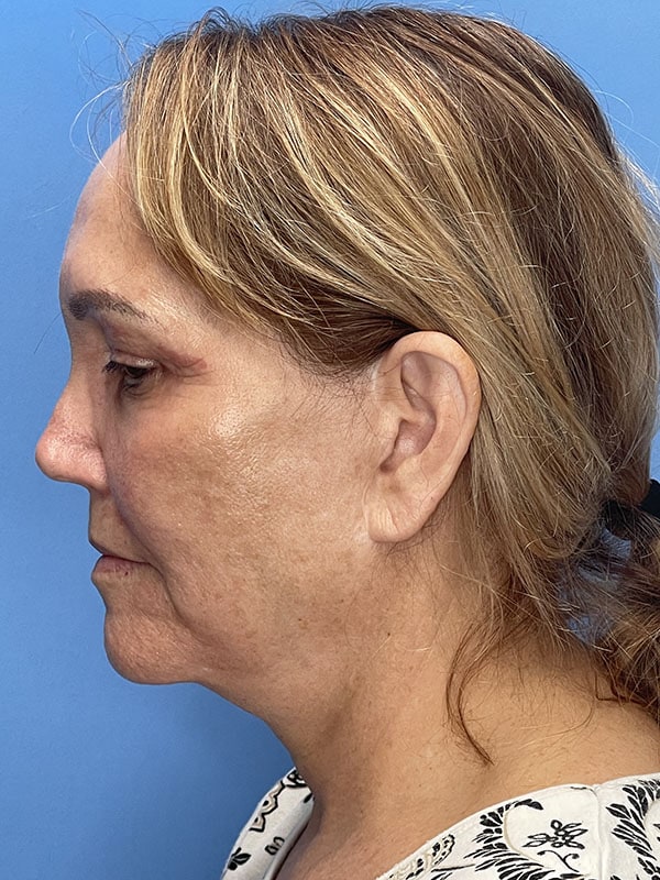 Revision Facelift Before & After Image