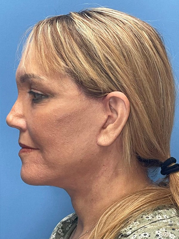 Revision Facelift Before & After Image