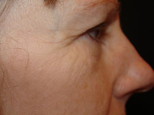 Cheek Implants Before & After Image