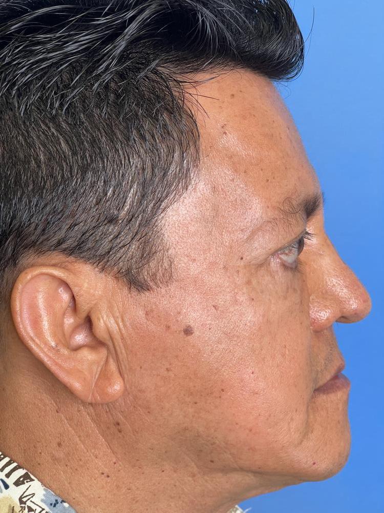 Cheek Implants Before & After Image