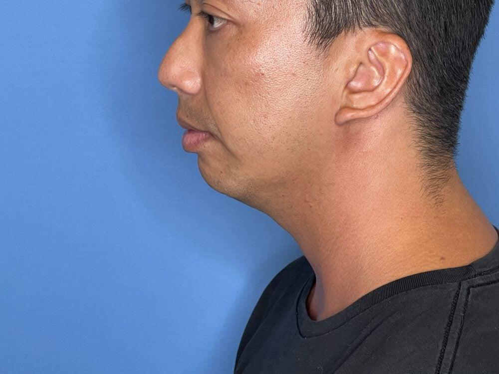 Chin Implants Before & After Image