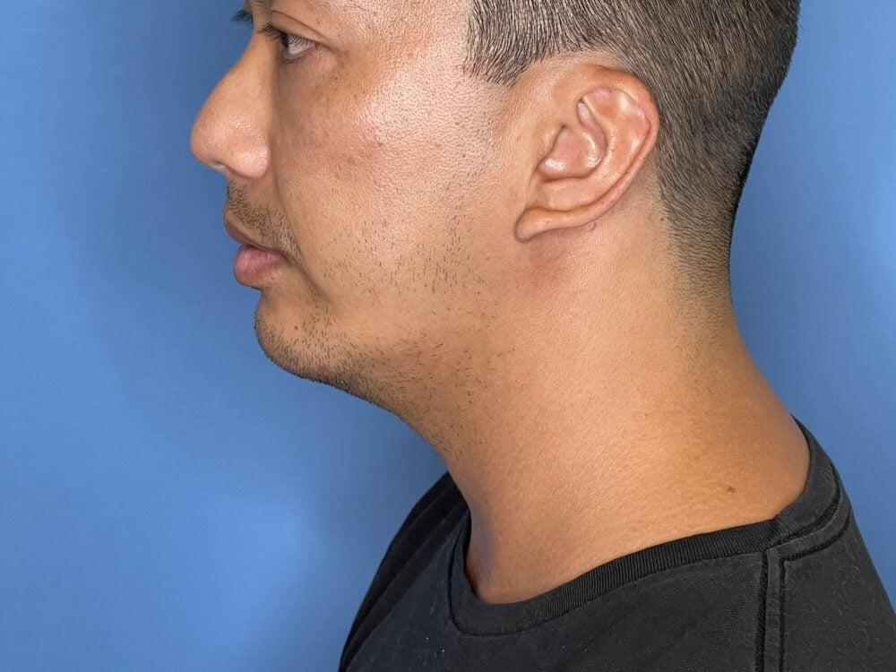 Chin Implants Before & After Image