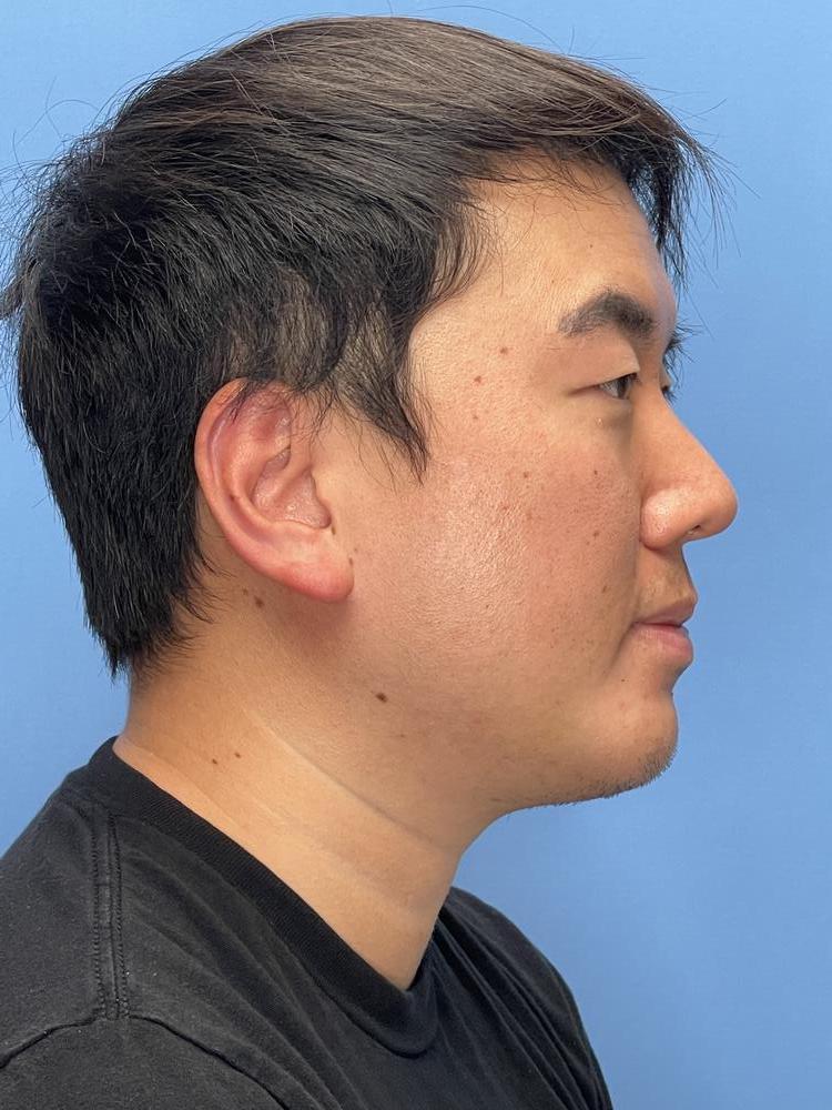 Chin Implants Before & After Image