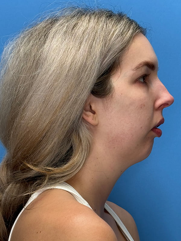 Chin Implants Before & After Image