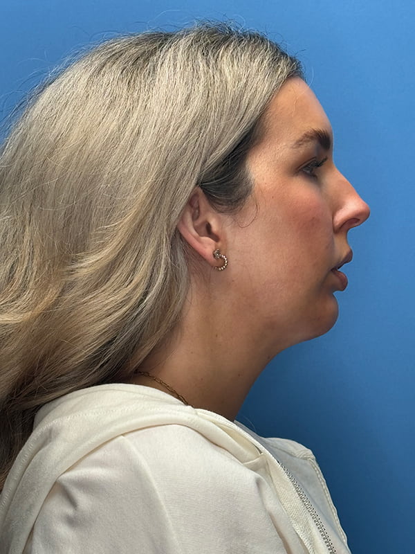 Chin Implants Before & After Image