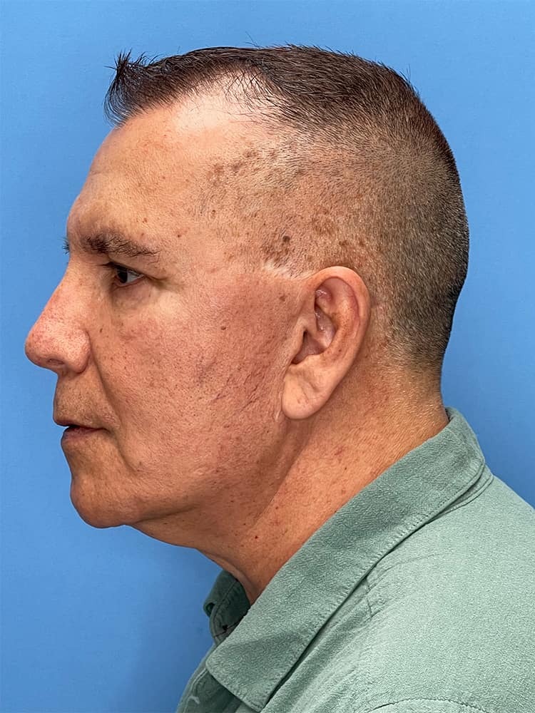 Custom Facial Implants Before & After Image