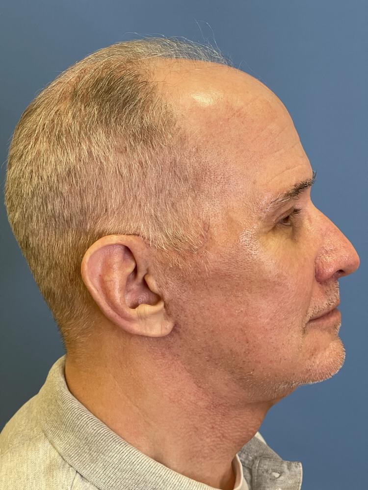 Custom Facial Implants Before & After Image